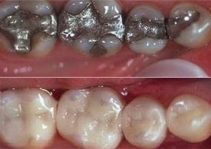 before and after results using CEREC Technology
