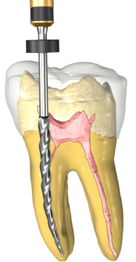 root canal dentist Temecula
