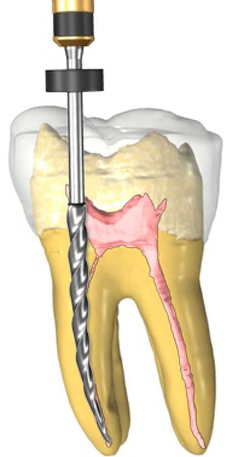 Stop the Pain, Save the Tooth: Why Root Canal Therapy Is Not the Enemy