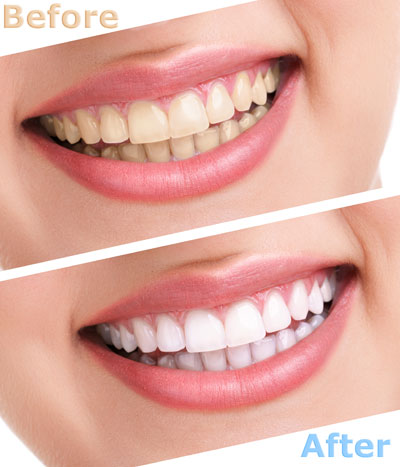 How Long Does Professional Teeth Whitening Last?